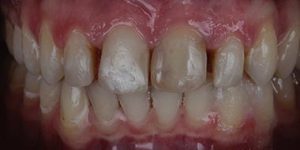 Сначала брекеты, потом импланты.