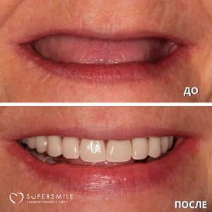 Что лучше: имплантация или протезирование зубов?