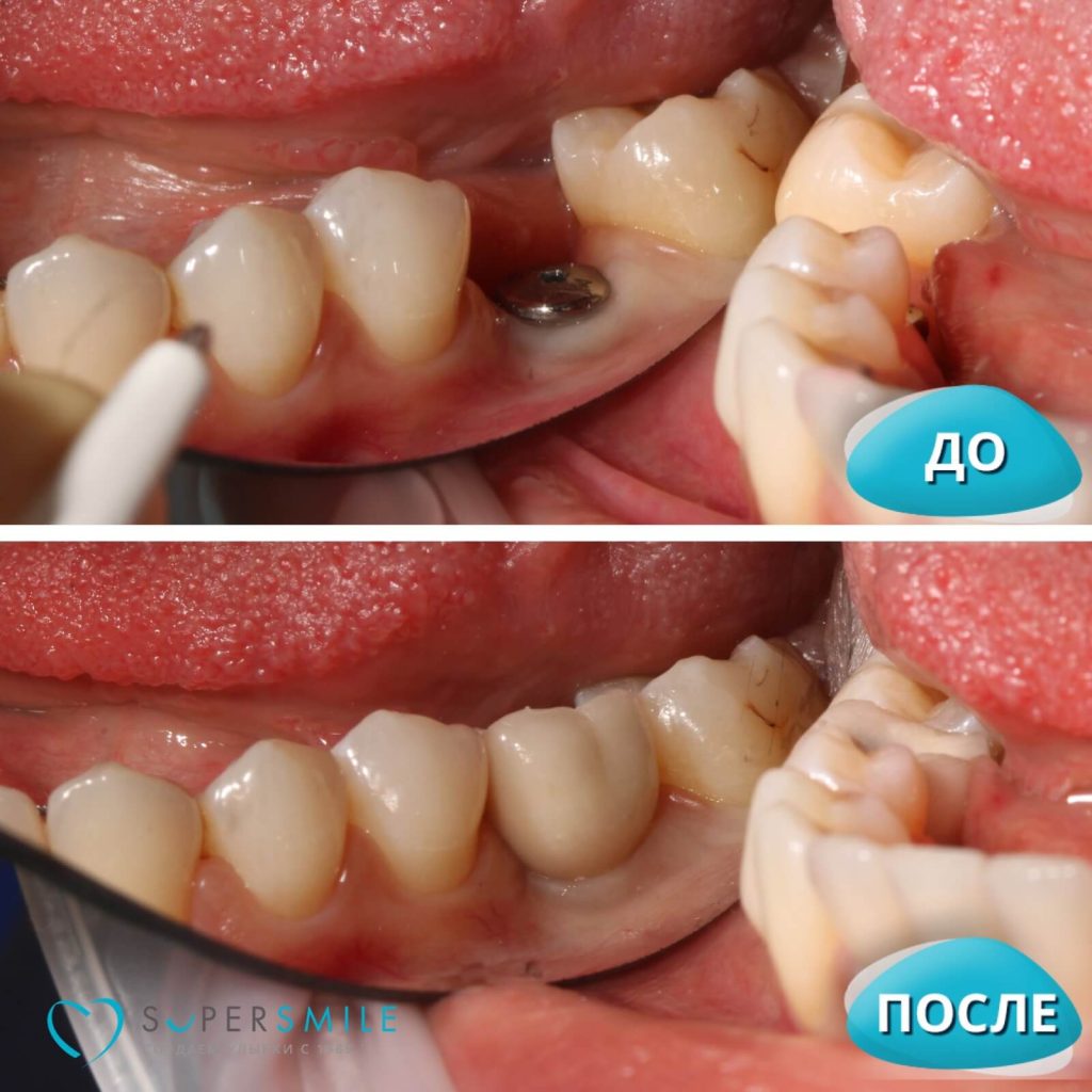 До/После №15461