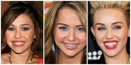 Брекеты и виниры сделают идеальной любую улыбку