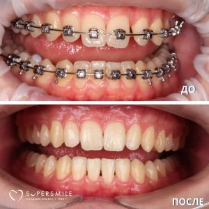 Установка брекетов