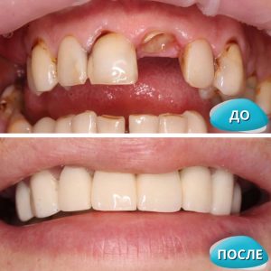 До/После №15437