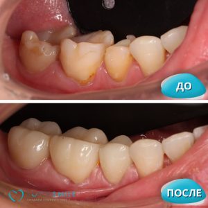 Установка коронок (до/после)