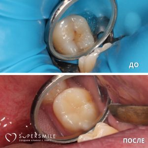 Лечение кариеса