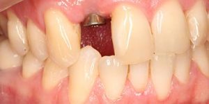 Имплантация без брекетов.