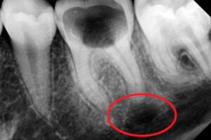 Особенности установки импланта после кисты зуба