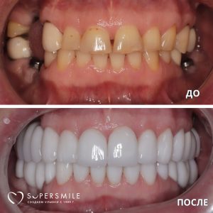 Установка виниров и коронок