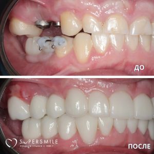 Выравнивание и протезирование