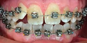 Патология окклюзии (прикуса).