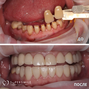 До/После №15369