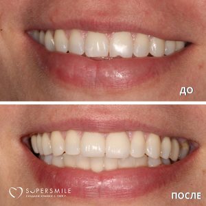 Установка виниров (до/после)