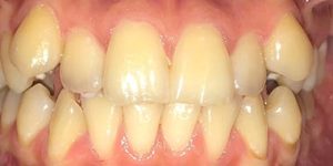 Скученное положение зубов.