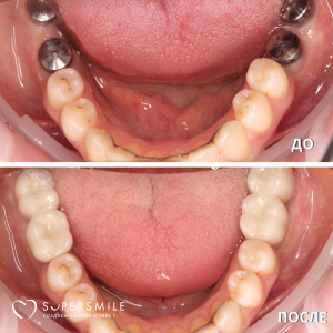 До/После №16177