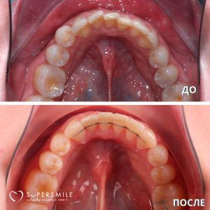 Импланты на жевательные зубы: что лучше?