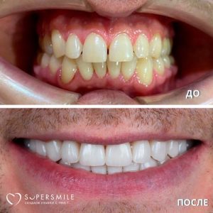 До/После №6798