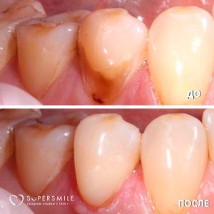 До/После №6435