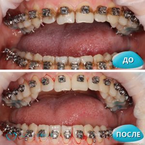 Профессиональная гигиена (до/после)