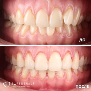 Исправление неприавльного прикуса