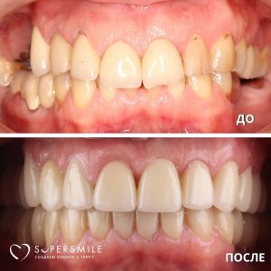 Имплантирование и установка коронок