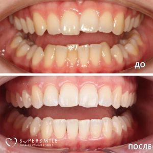 Исправление прикуса — это не только про эстетику