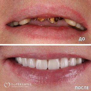 До/После №13934