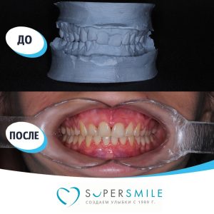 Исправление дистального глубокого прикуса. Результаты лечения
