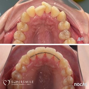 Исправление скученности зубов