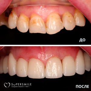 Протезирование зубов (до/после)