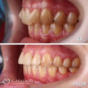 Ортодонтическое лечение на брекетах.