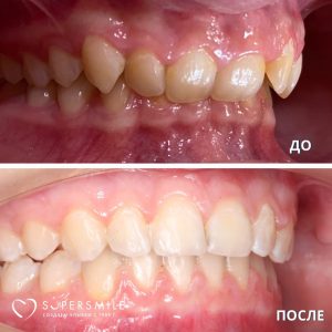 Лечение глубокого прикуса