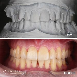 Исправление прикуса (до/после)