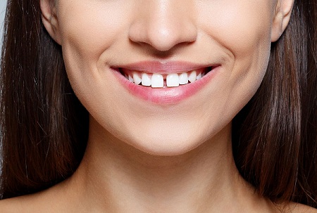 Брекеты: а что, если… Врачи-ортодонты клиники «Super Smile» отвечают на вопросы