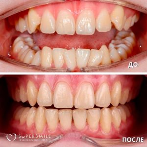Исправление прикуса (до/после)