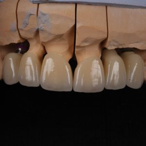 Установка имплантов и коронок