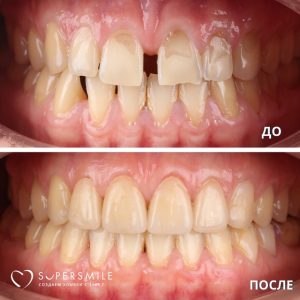 Диастема и установка виниров
