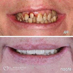 Установка виниров (до/после)