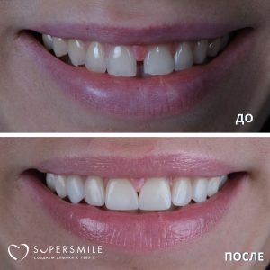 До/После №13932