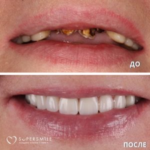 Удаление и протезирование зубов