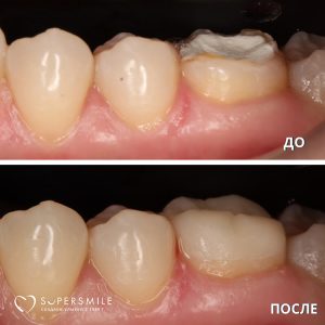 Протезирование (до/после)