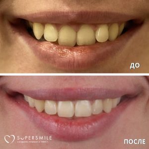 Исправление прикуса (до/после)