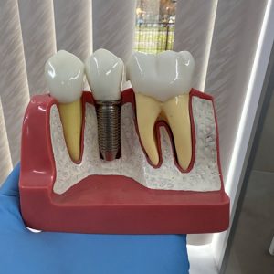 Импланты Alpha Bio: надежная альтернатива премиум-сегменту по доступной цене