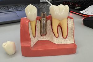 Ответы на 10 самых распространенных вопросов: все, что вы хотели знать об имплантации зубов