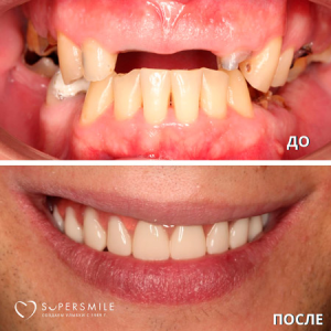 Сколько имплантатов можно установить за один раз?