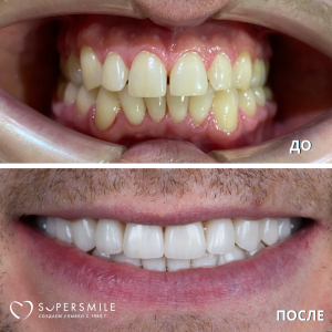 Установка виниров (до/после)