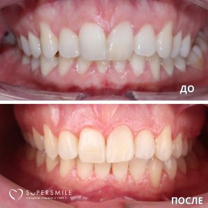 До/После №5279