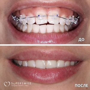 До/После №5280