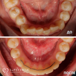 Выраженная скученность нижних передних зубов