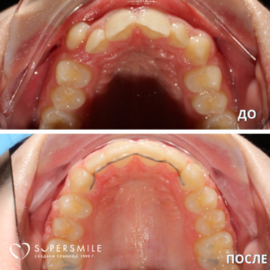 Преображение улыбки после лечения у ортодонта