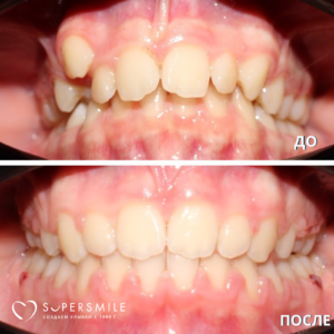 Результат комплексной ортодонтической работы