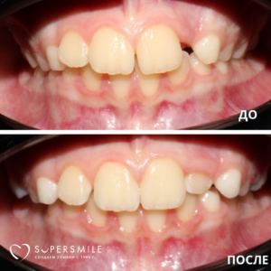 До/после, где зуба… просто не было.